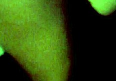 New Tattoo With Braces