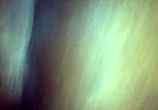 The patient receives a chocolate glaze treatment in the hospital