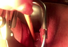 子宮頸部を伸ばしてサウンド—どれだけ深く入る？