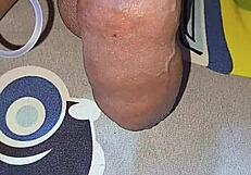 myanmar gay guy gets homemade saline injection for bigger cock