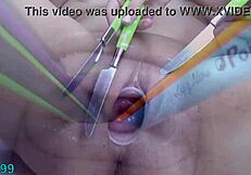 prolapsed cervix lesbians at the same time